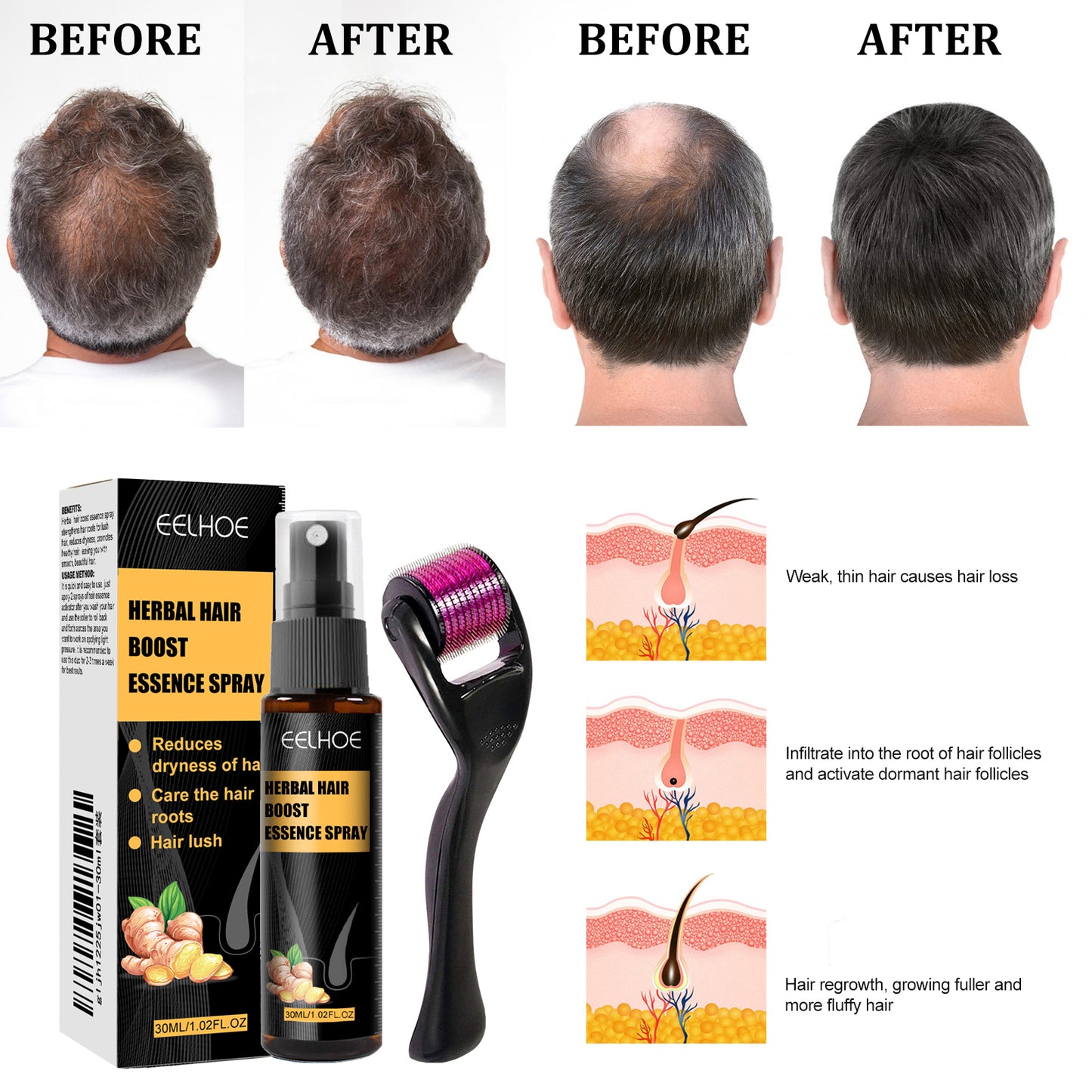 Derma Roller with Herbal Hair Spray